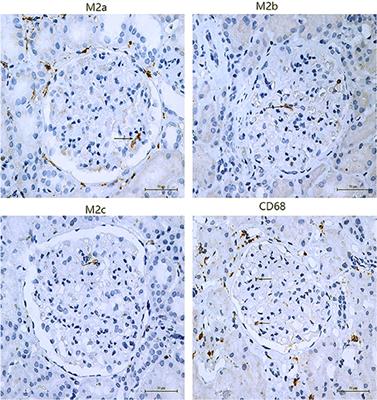 M2 Macrophage Subpopulations in Glomeruli Are Associated With the Deposition of IgG Subclasses and Complements in Primary Membranous Nephropathy
